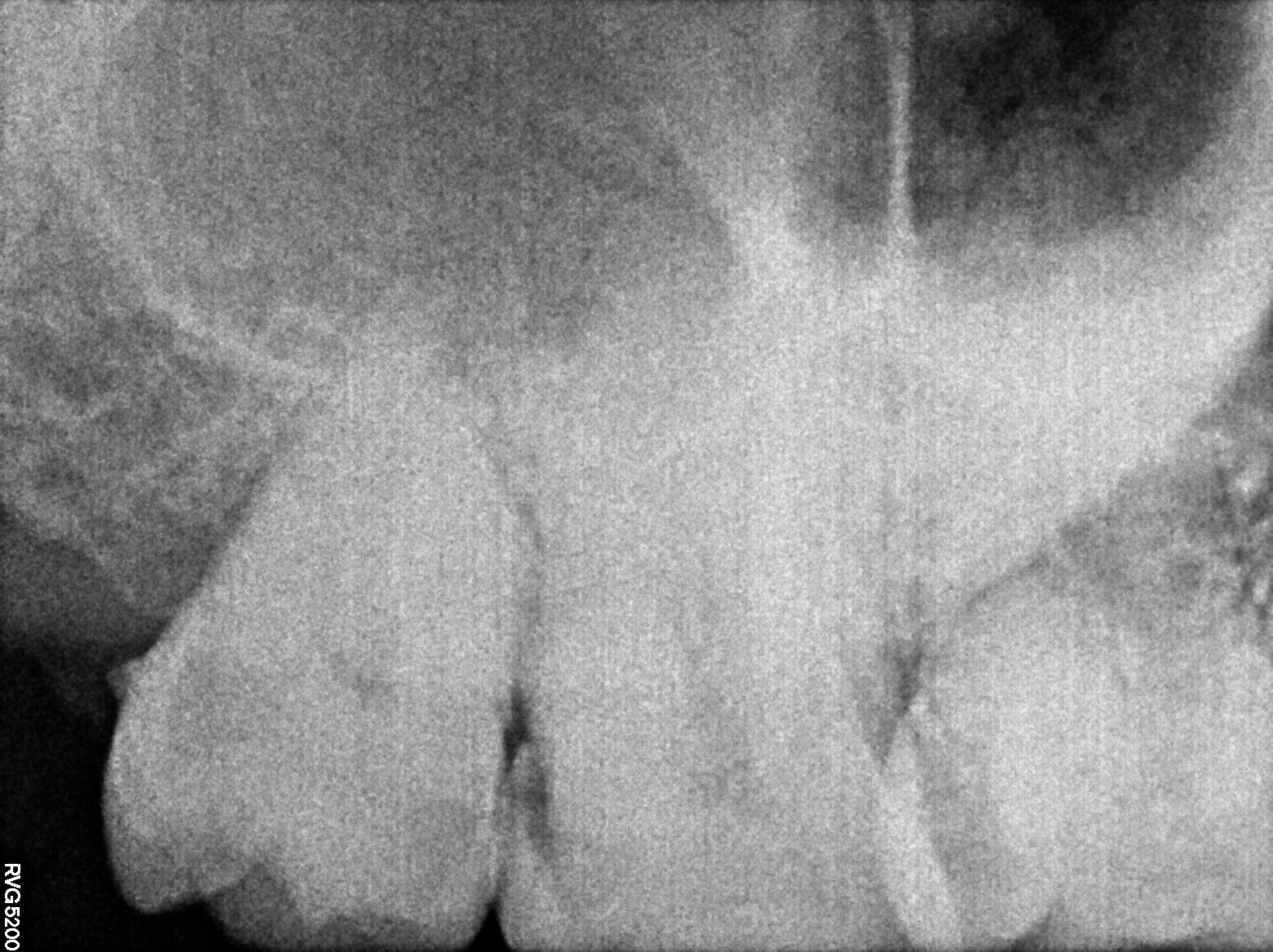 Dental X-ray